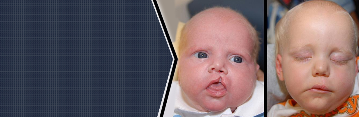 Where can I get a cleft lip and cleft palate surgery done?
