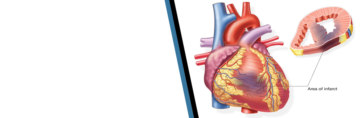 Which antiplatelet should we use in acute MI and why?