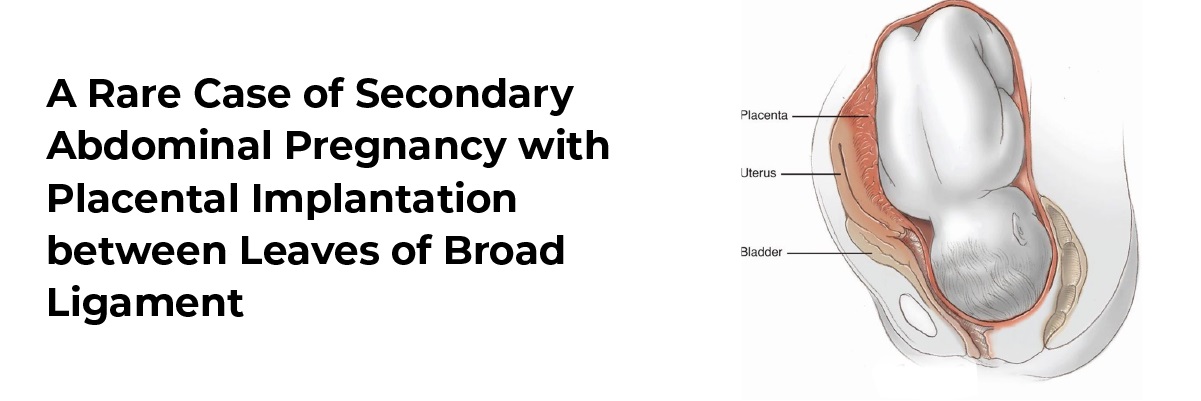 A Rare Case of Secondary Abdominal Pregnancy with Placental Implantation between Leaves of Broad Ligament