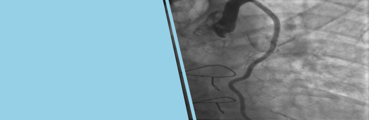 When is bypass done along with angiography?