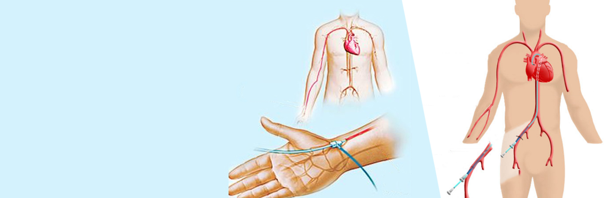 Radial angiography & angioplasty vs. Femoral angiography & angioplasty?