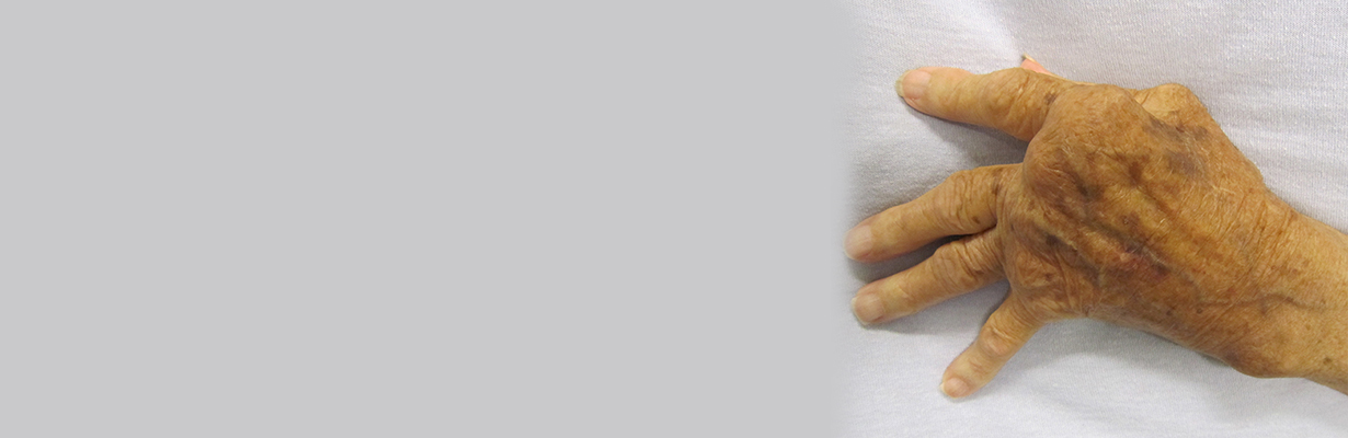 When should we start biologics Rheumatoid Arthritis?