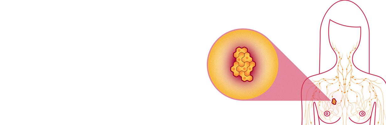What is the survival rate for breast cancer in different  stage?