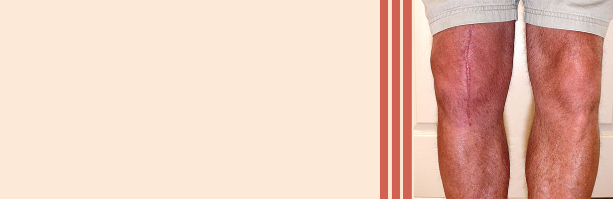 What are the complications after knee replacement?