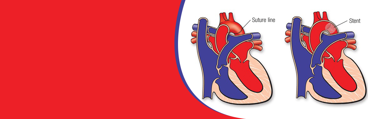 When do we intervene in a patient with coarctation of aorta in children?