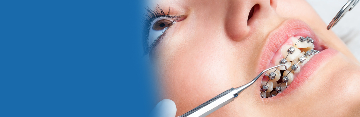 What everybody should know about dental braces?