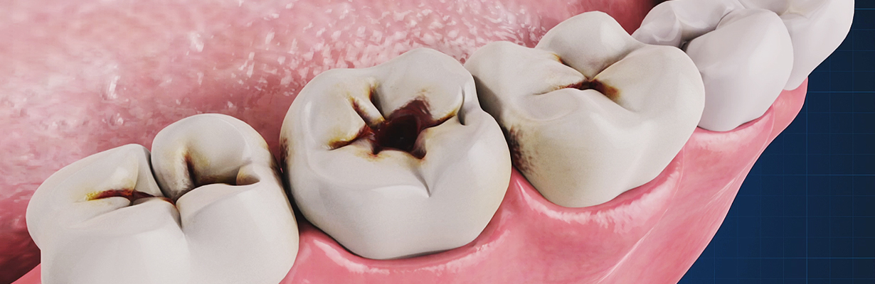What everybody should know about dental caries?