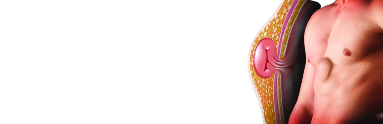 Hernia Diet - What Should I Eat/Avoid ?