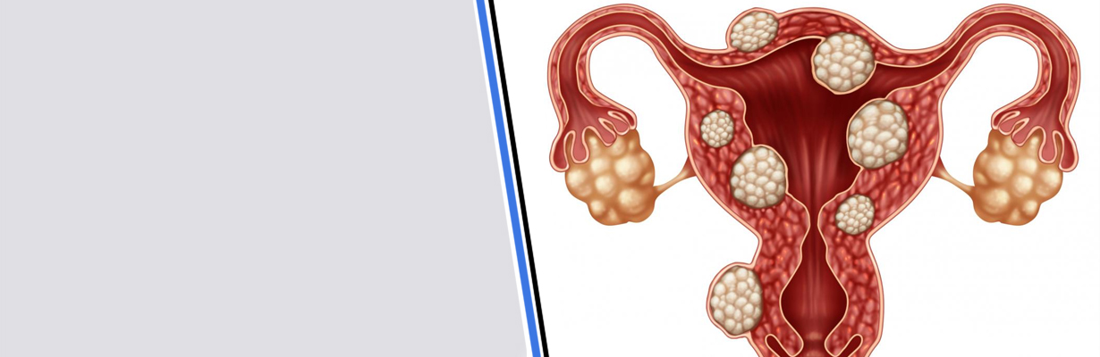 What is the treatment for fibroid?