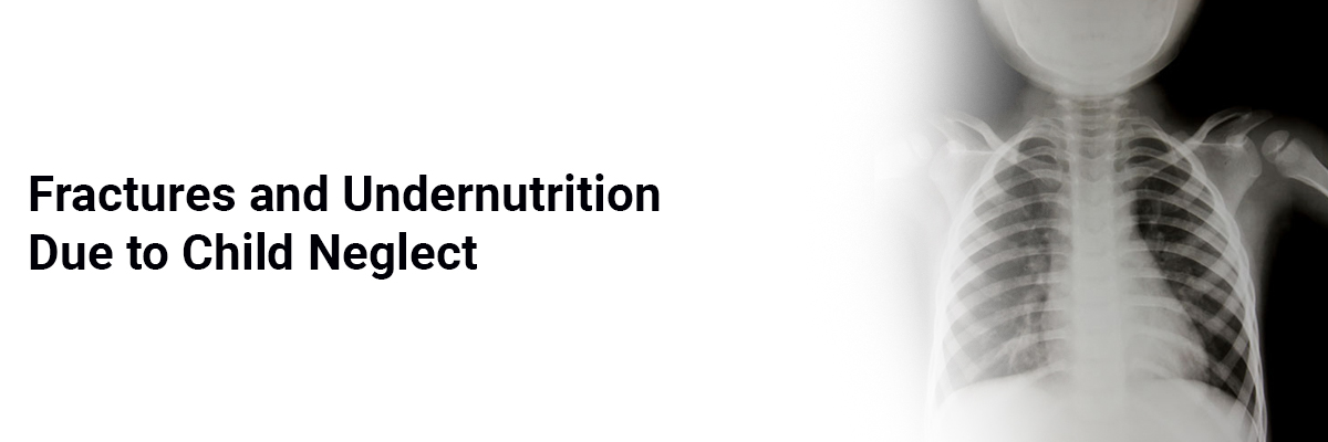 Fractures and Undernutrition due to Child Neglect