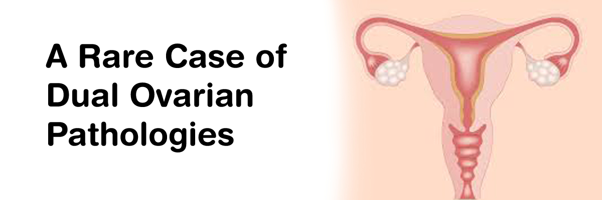 A Rare case of Dual Ovarian Pathologies