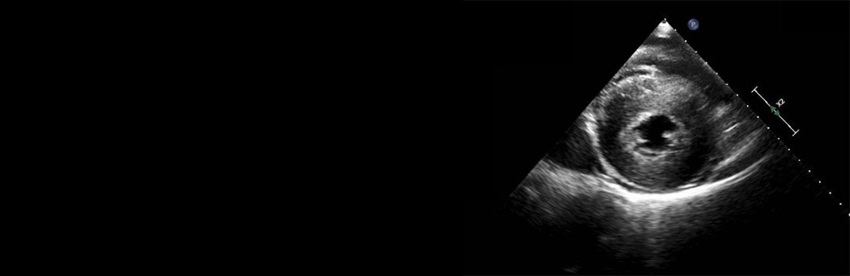 What is the importance of LVH on echocardiography?