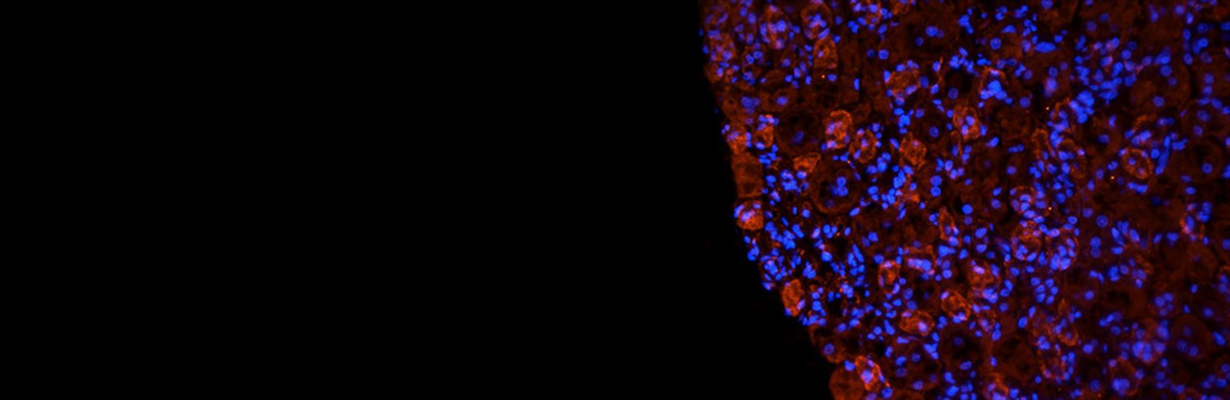 Is NTTCP antibody diagnostic for rheumatoid arthritis?