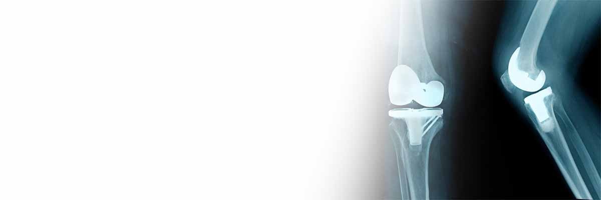 Unilateral vs bilateral knee replacement?