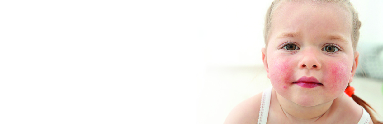 Mouth breathing and skin disease in children?