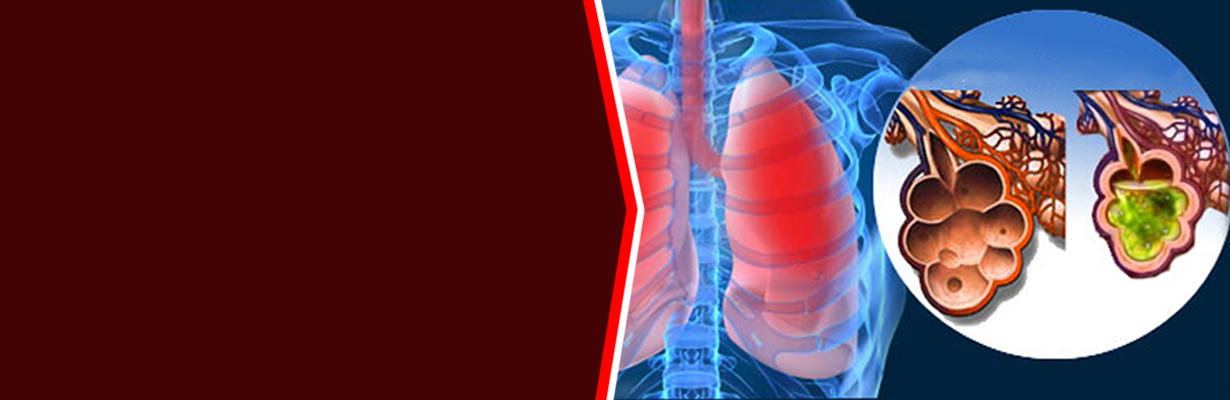 What is the management of acute respiratory distress syndrome (ARDS)?