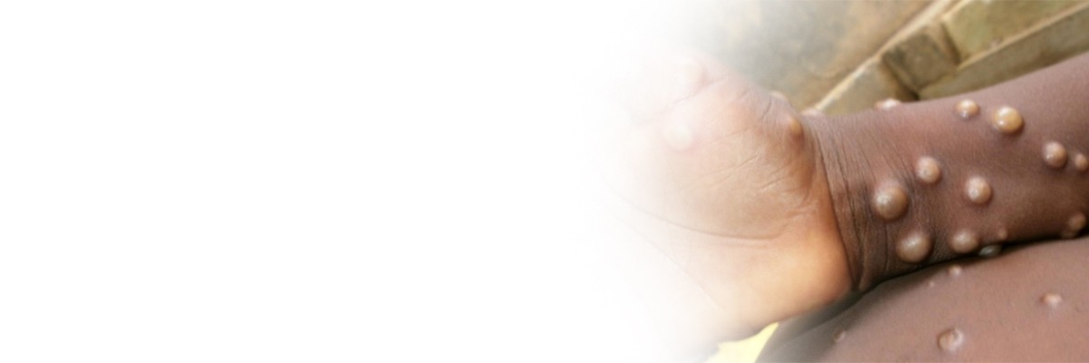 Monkeypox Virus : Disease Control and Prevention