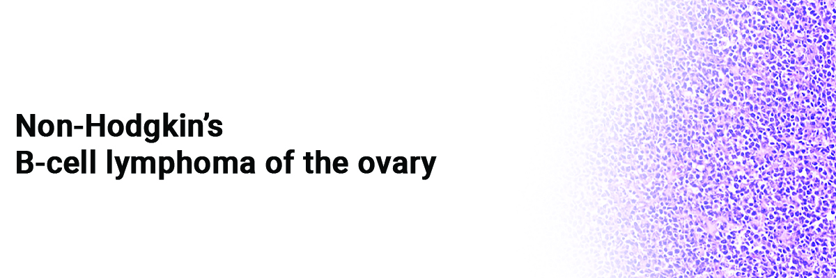 Non-Hodgkin's B-cell lymphoma of the ovary