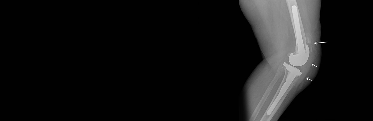 What is Patellar knee replacement?