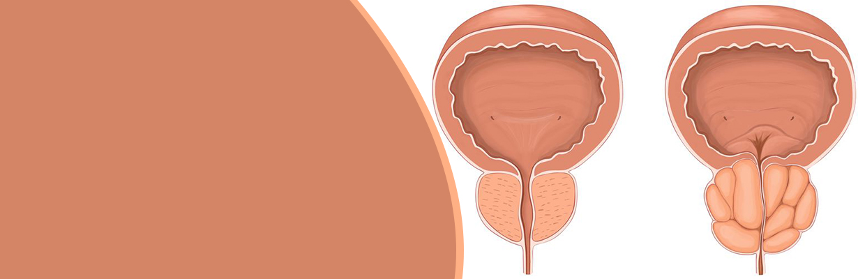 Tadalafil Viagra cure prostate enlargement?