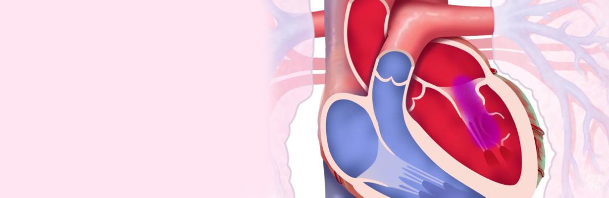 What are the indications for not intervening pure mitral stenosis?