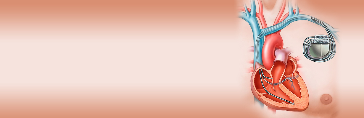 What are the reasons for pacemaker failure?