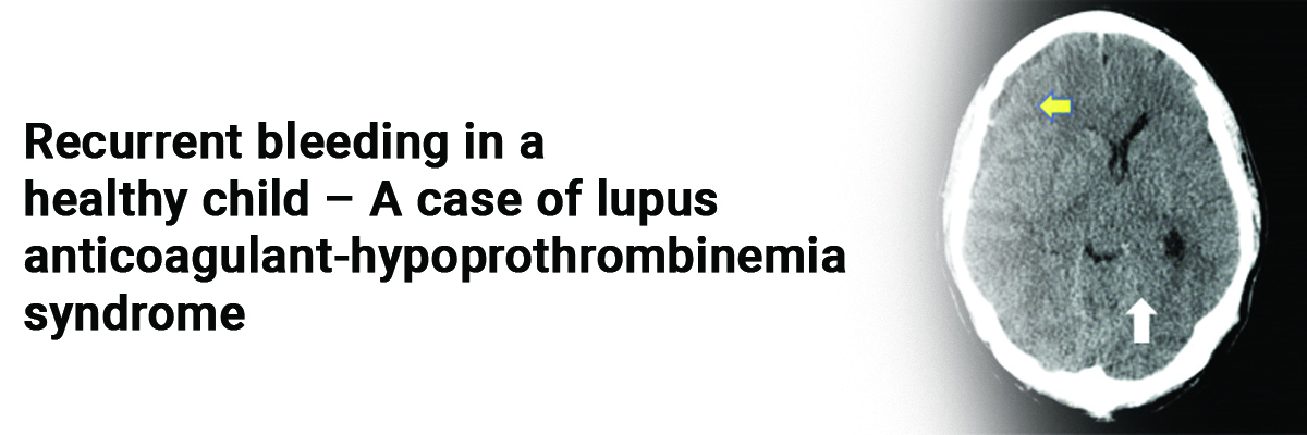 Recurrent bleeding in a healthy child – A case of lupus anticoagulant-hypoprothrombinemia syndrome