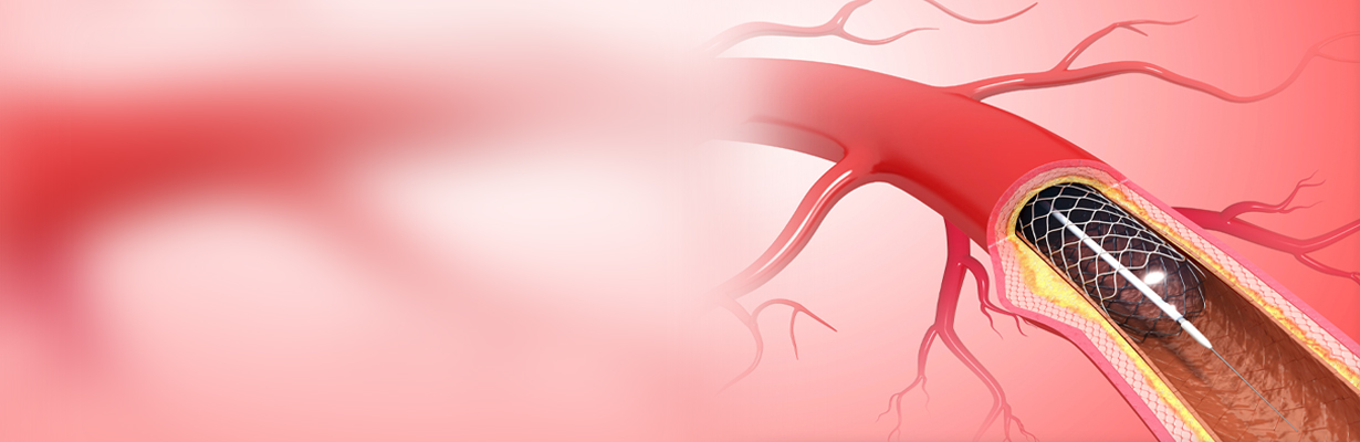What are the second generation stents?