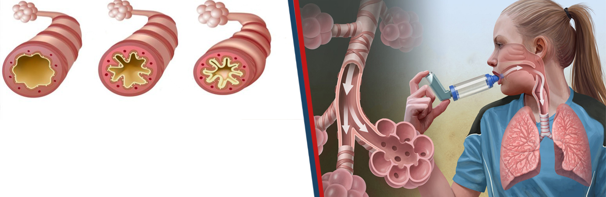 What is the formula of two to classify the severity of asthma?