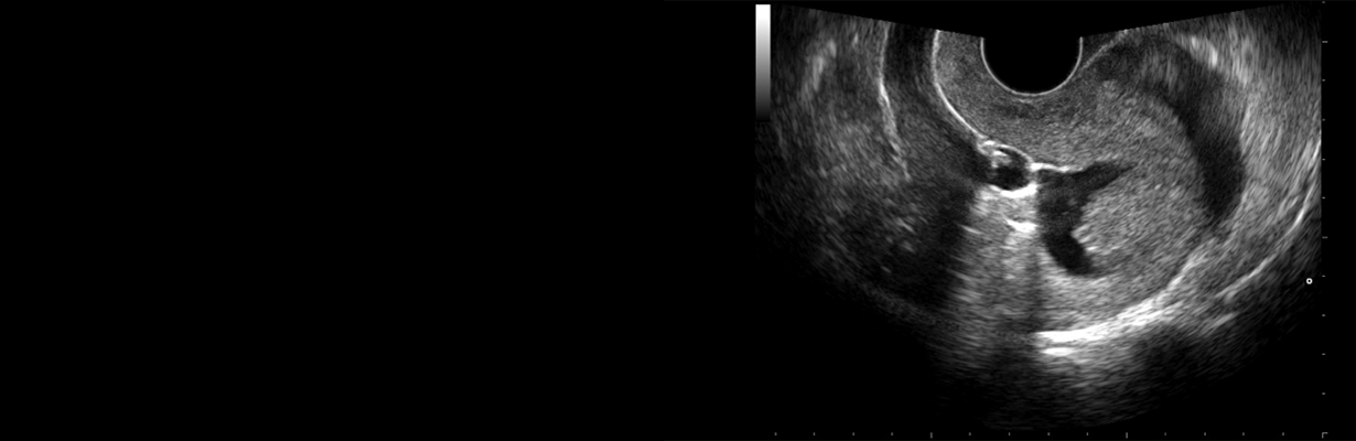 What is sonohysterogram in infertility?