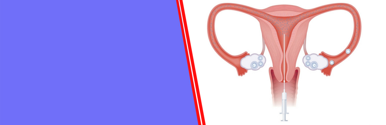 What is the success rate of IUI?