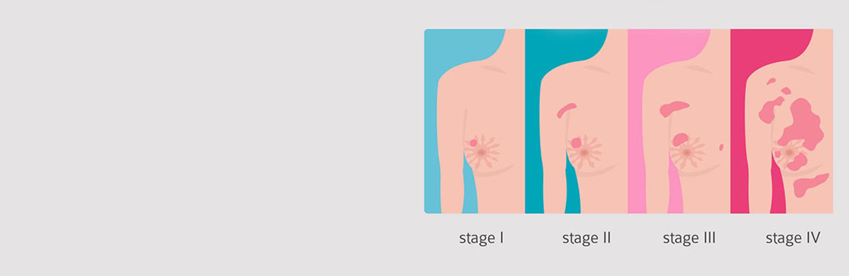 What is staging in Breast Cancer?