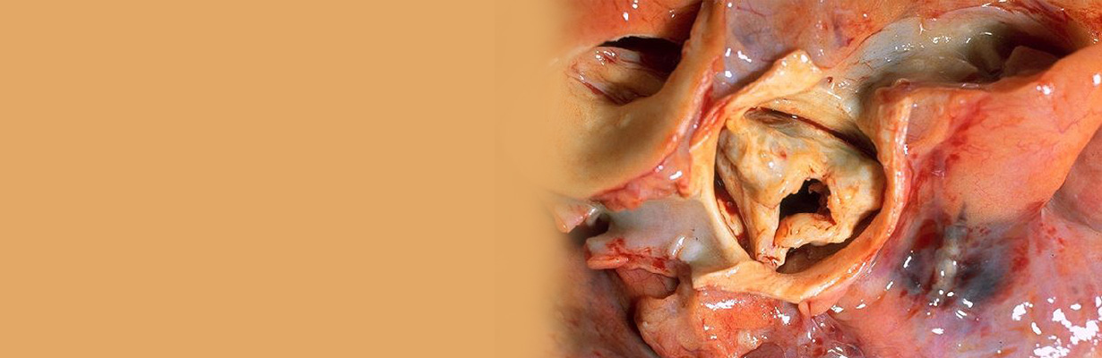 How is aortic stenosis treated?