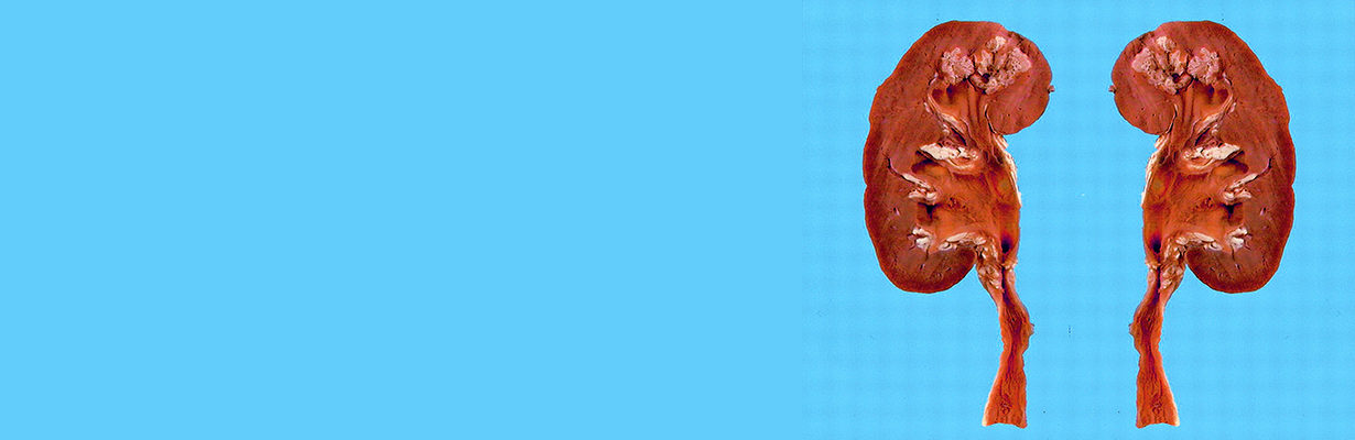 What is the Tuberculosis of the kidney?