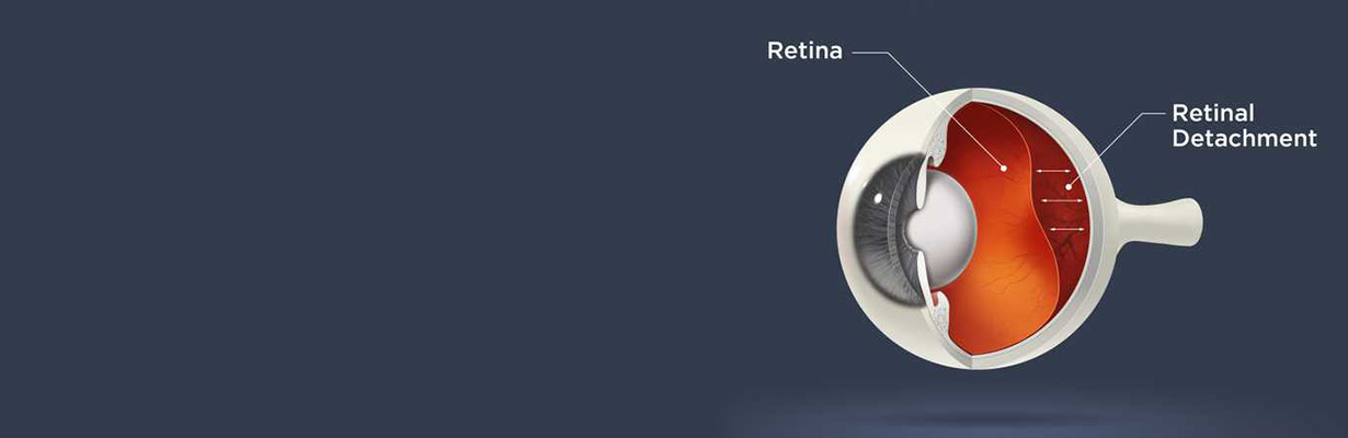 What is Retinal Detachment?