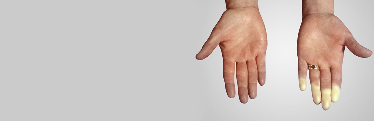 What is systemic sclerosis?