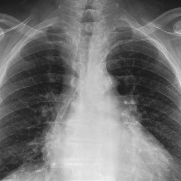 Deep Learning Analysis of Chest Radiographs for Differentiating Between Congenital Ventricular Septal Defect and Atrial Septal Defect in Children