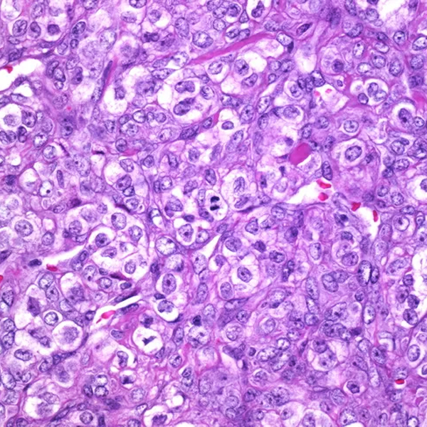 Analysis of a Case Report of Sclerosing...