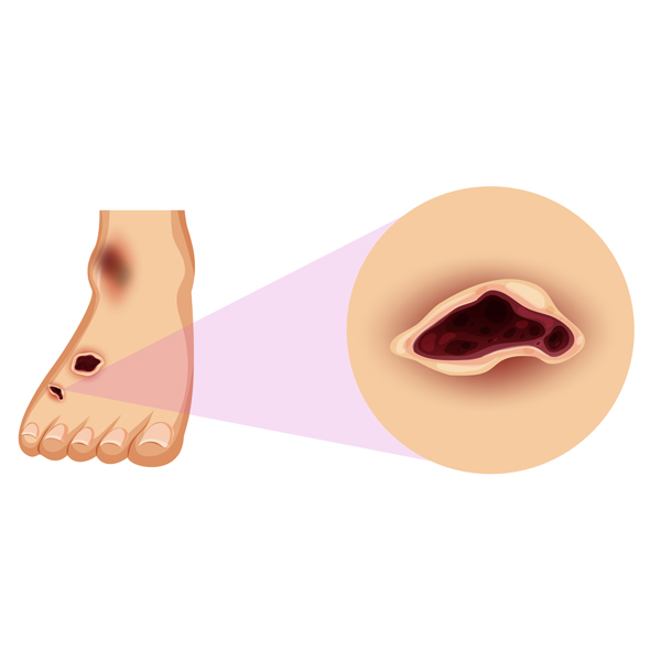 Diabetic Foot: Screening and Management