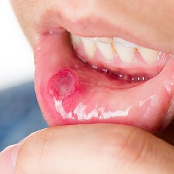 Oral Infections: Prevention Do's and Don'ts
