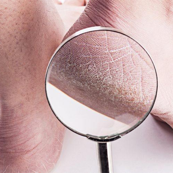 Cracked Heels To Foot Infections: One Solution For Multiple Problems