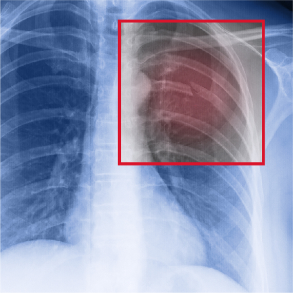 रिब फ्रैक्चर क्या है? कारण, लक्षण और इलाज Rib Fracture in Hindi