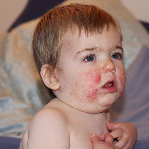 Herpes Zoster Ophthalmicus In Children