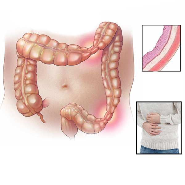 How is Irritable bowel syndrome related to stress?