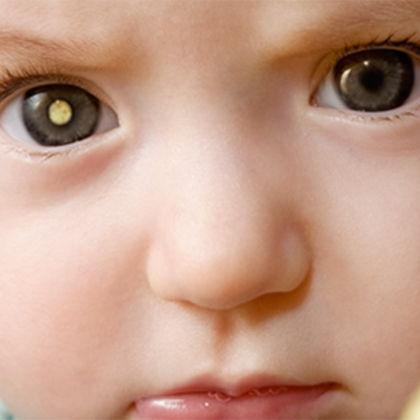 How is cataract managed in children?
