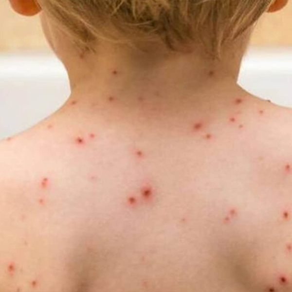 Monkeypox Rash Baby Monkeypox in pediatric age