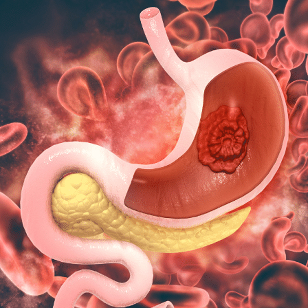 Peptic Ulcers: Causes, Symptoms and Treatment