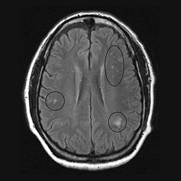 Vitamin B12 Deficiency Can Lead to Reversible Basal Ganglia Changes in