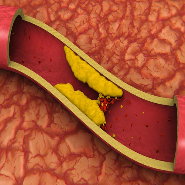What happens when an artery gets blocked?