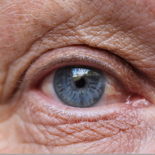 What is Age related macular Degeneration?